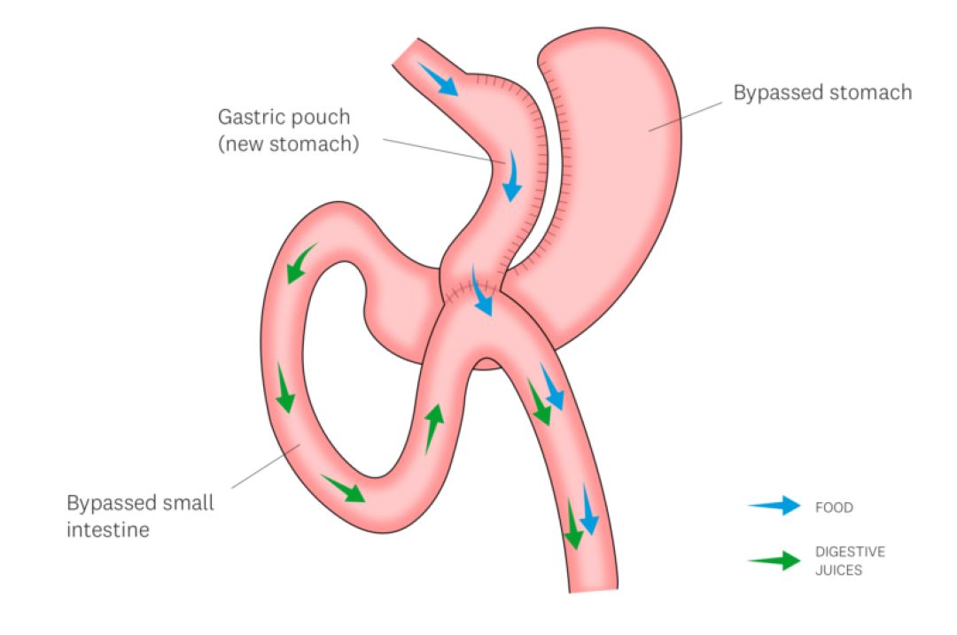 one-anastomosis-gastric-bypass-800x531.png